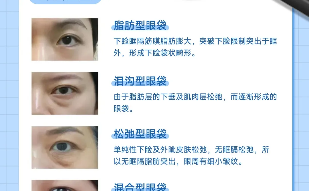 眼袋修复|卧蚕重塑，灵动双眼