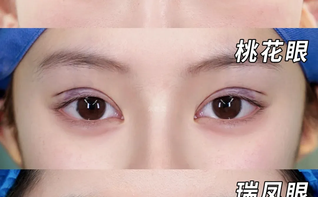 双眼皮模板来咯｜灵动自然一眼沦陷～
