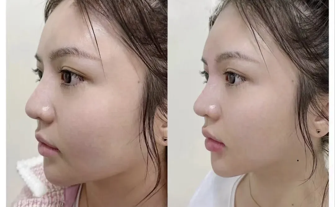 3K打造的精致小V脸