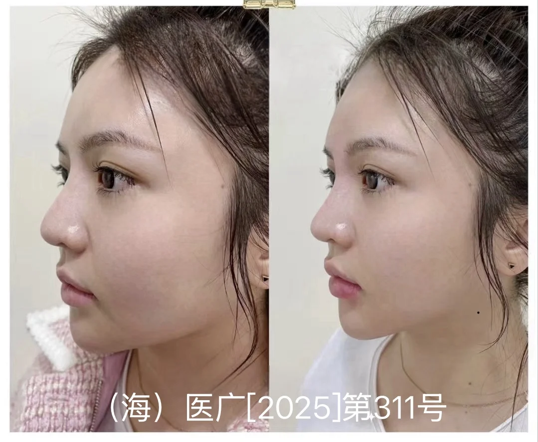 3K打造的精致小V脸