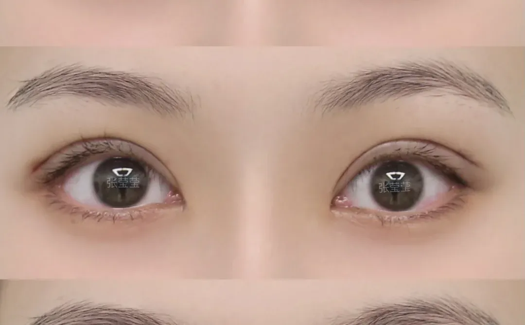 沈阳双眼皮| 开扇7毫米 眼睛自然放大
