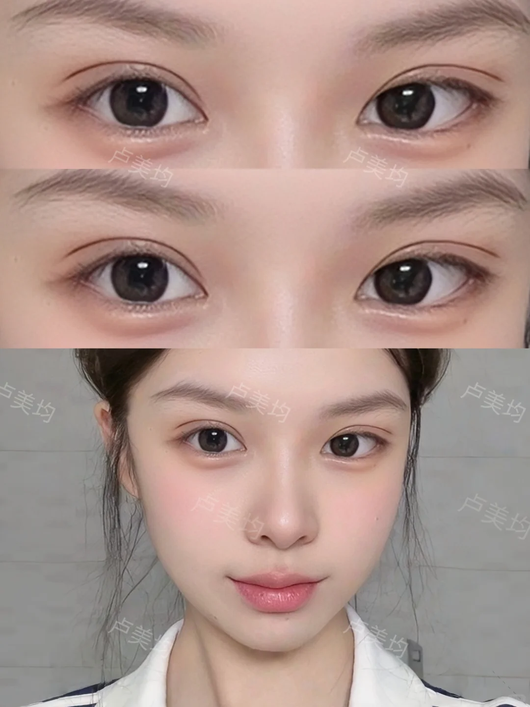 重庆双眼皮｜7mm开扇眼尾上扬纯欲眼～