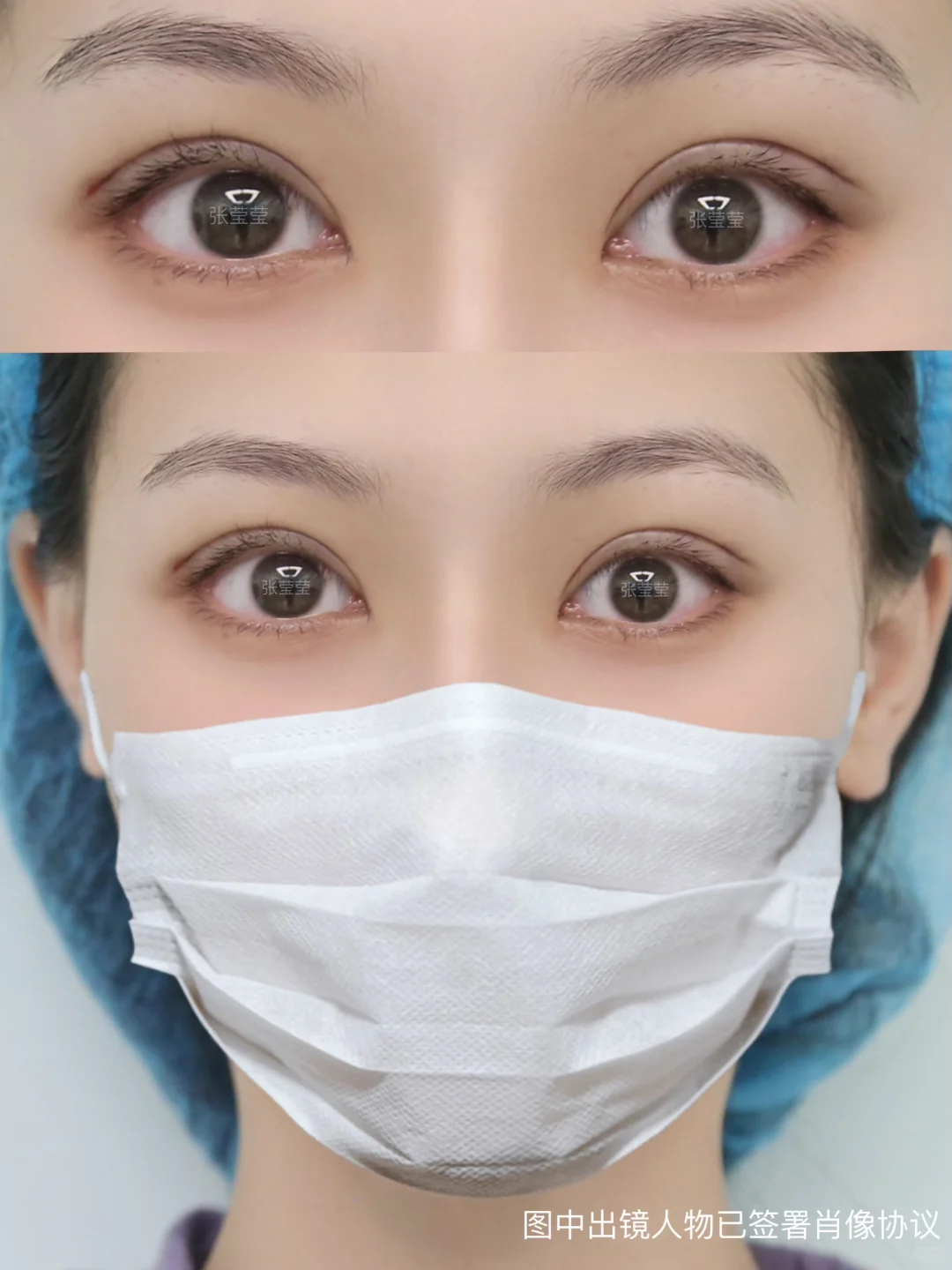 沈阳双眼皮| 开扇7毫米 眼睛自然放大