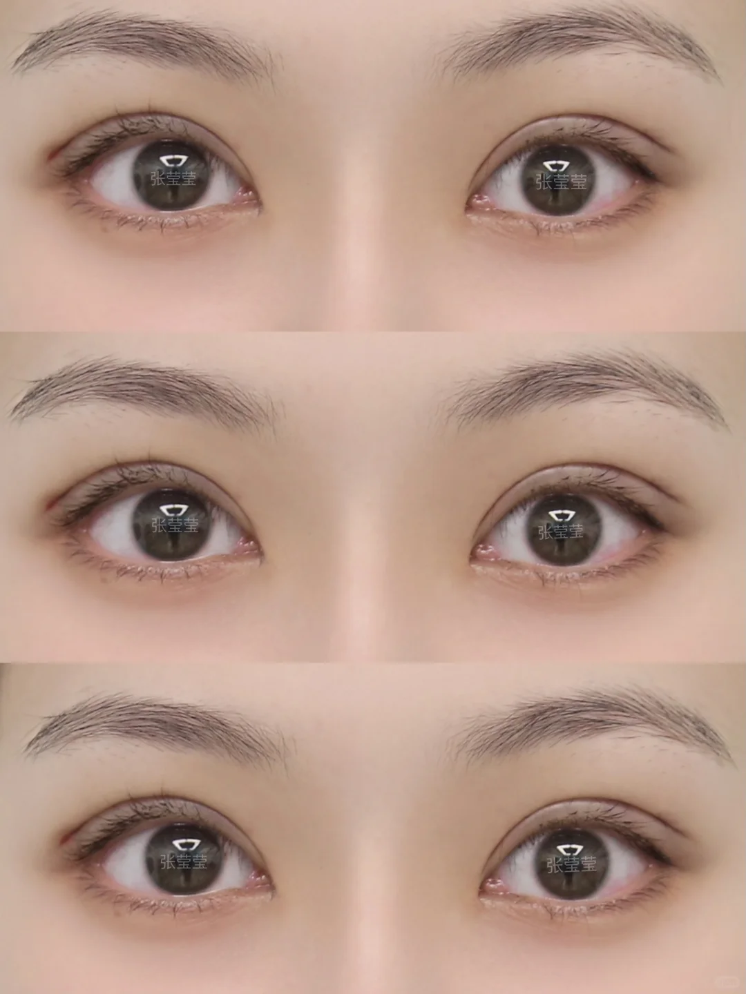 沈阳双眼皮| 开扇7毫米 眼睛自然放大