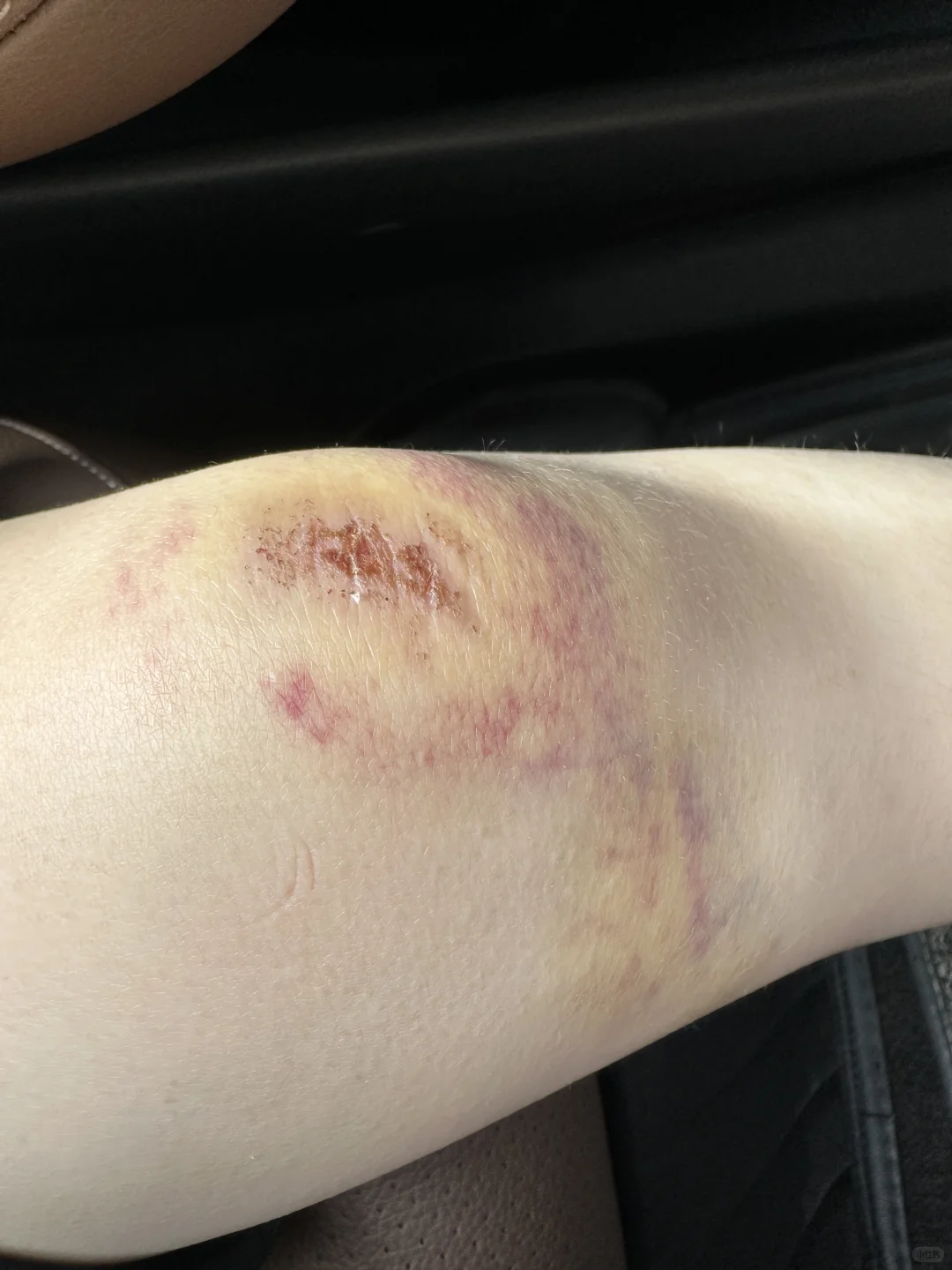 在澳洲被羊撞瘸了这正常吗?