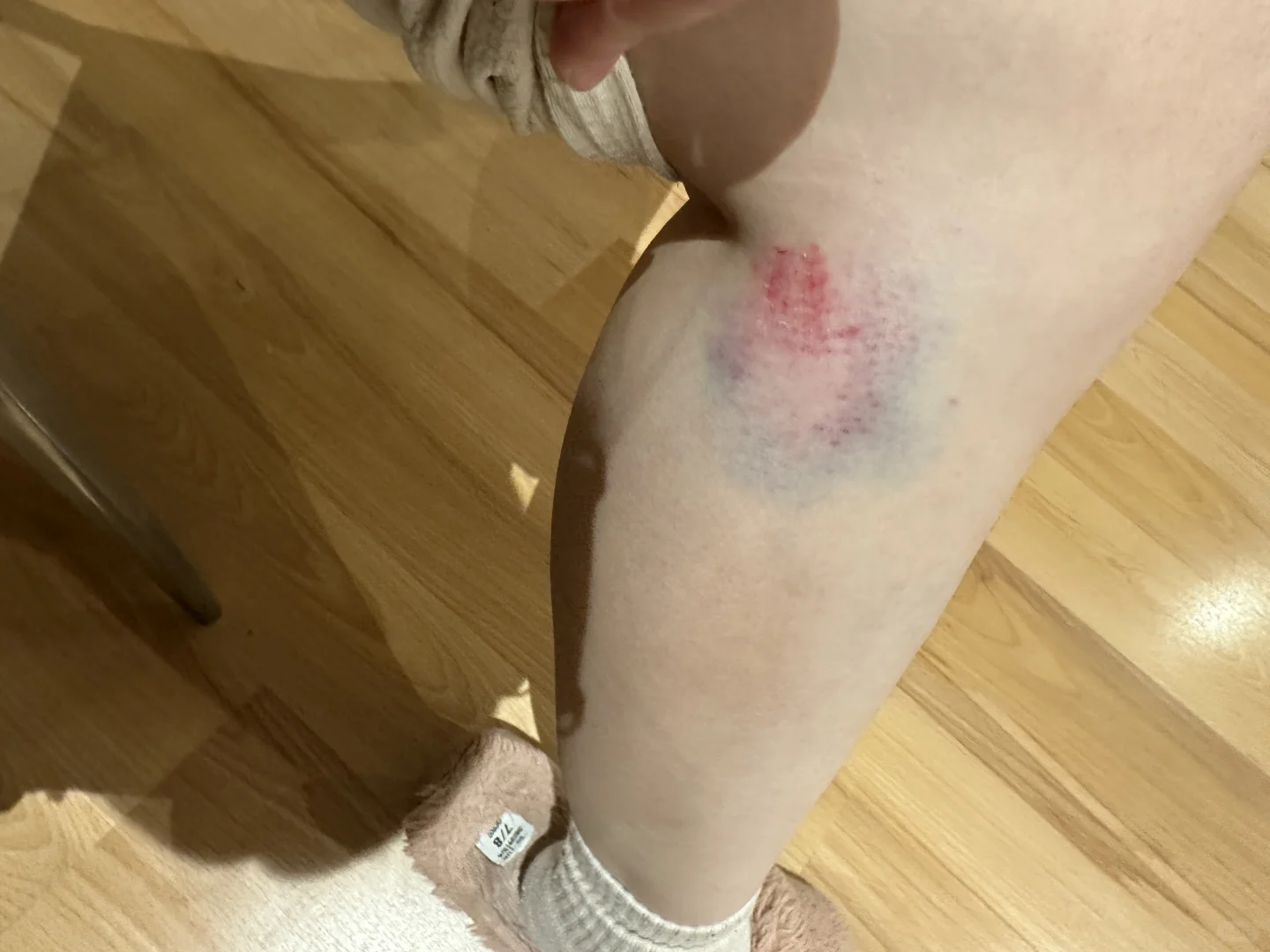 在澳洲被羊撞瘸了这正常吗?