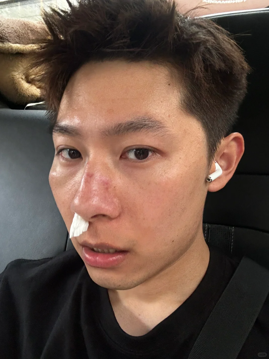 出门打了一架 脸上的伤疤是我的战利品