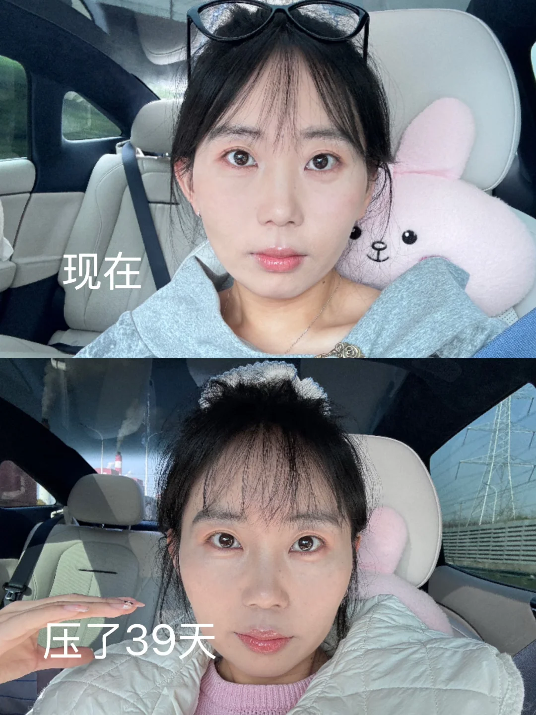 压颧骨第92天对比🆚