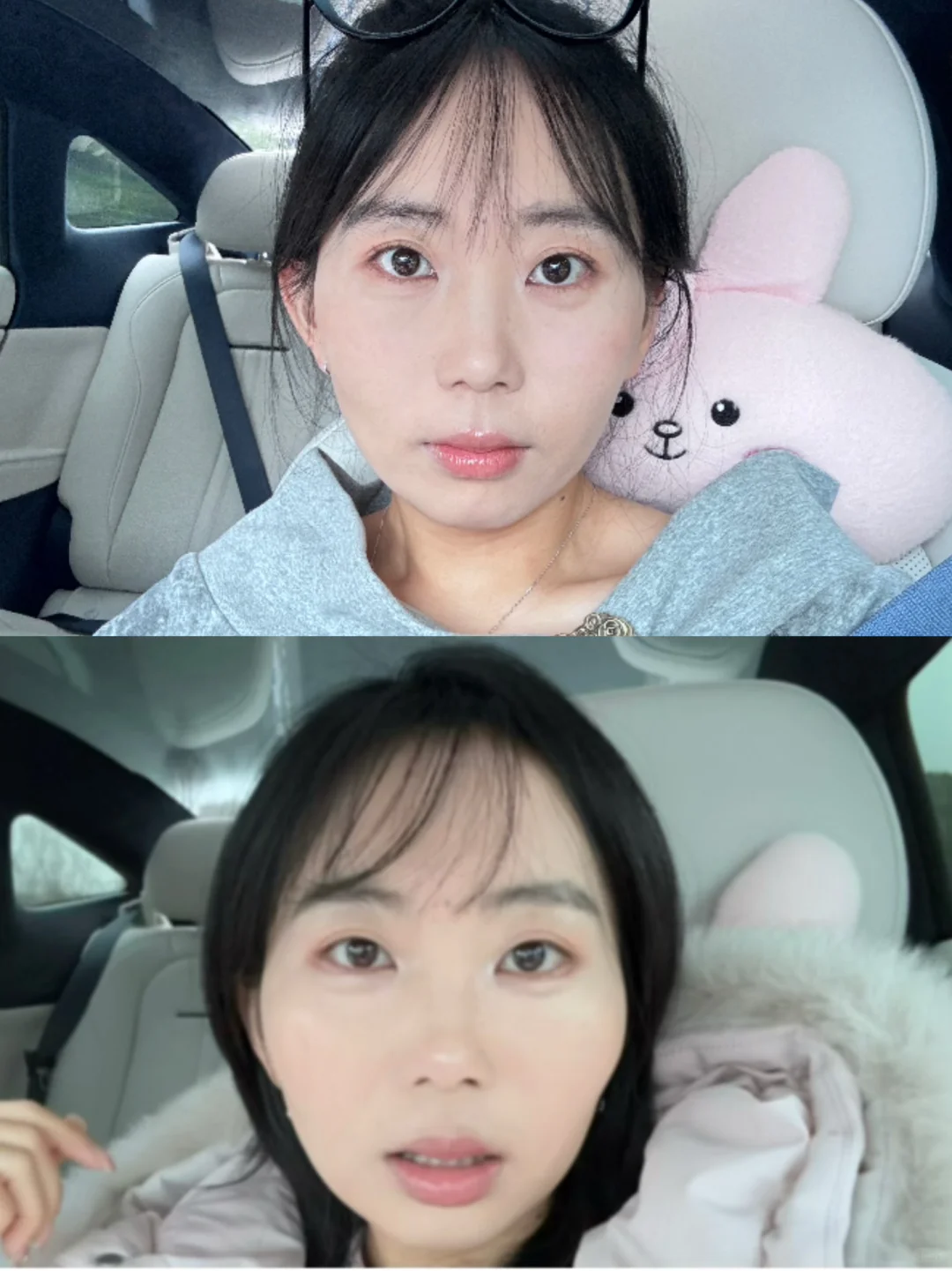 压颧骨第92天对比🆚