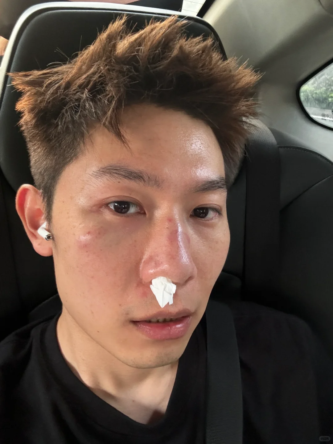 出门打了一架 脸上的伤疤是我的战利品