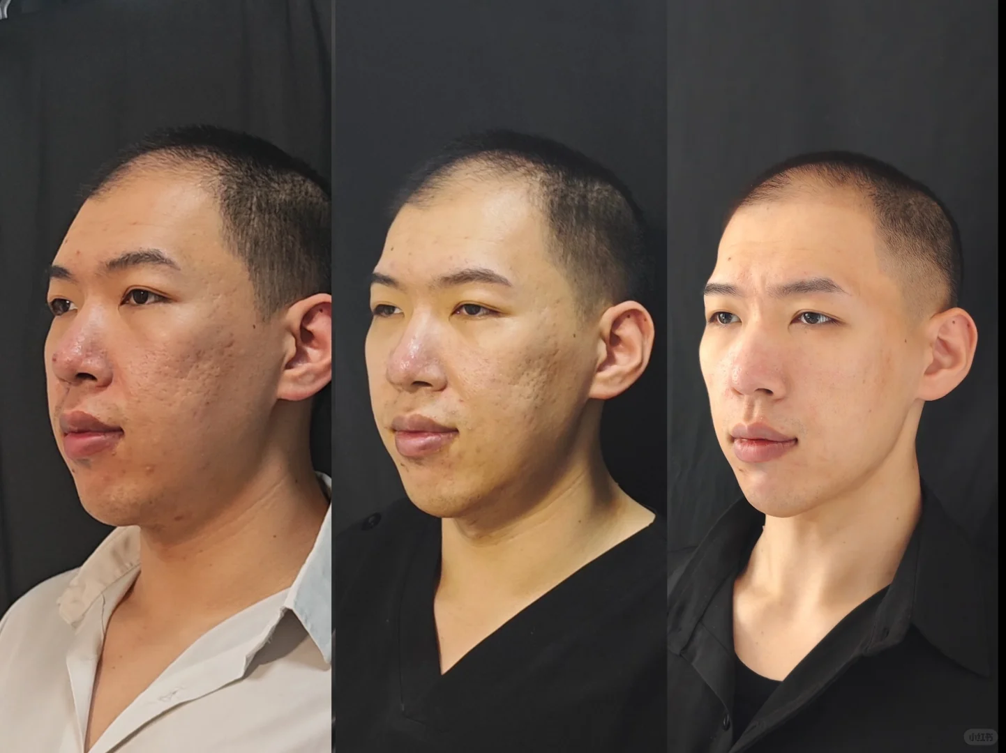 面部全脸定制