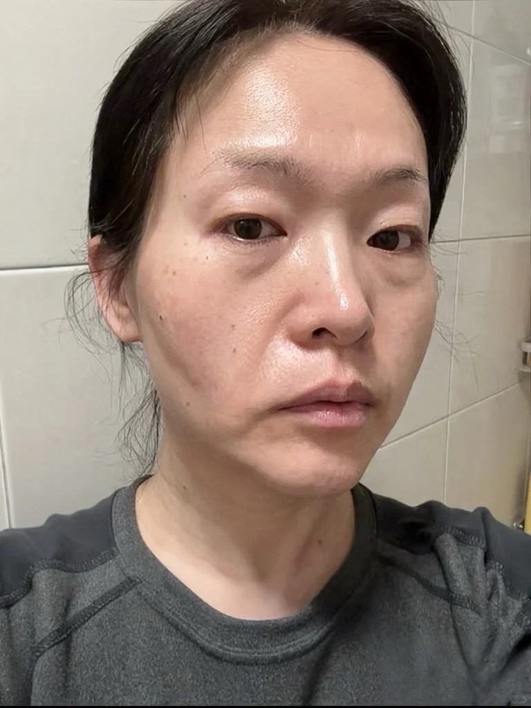 50岁阿姨垮脸之法令纹消失篇！