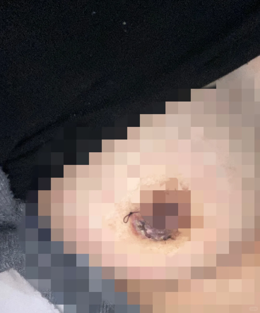 乳腺恢复这样正常吗？