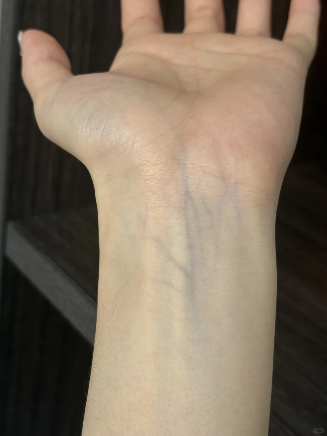 手腕血管这样正常吗