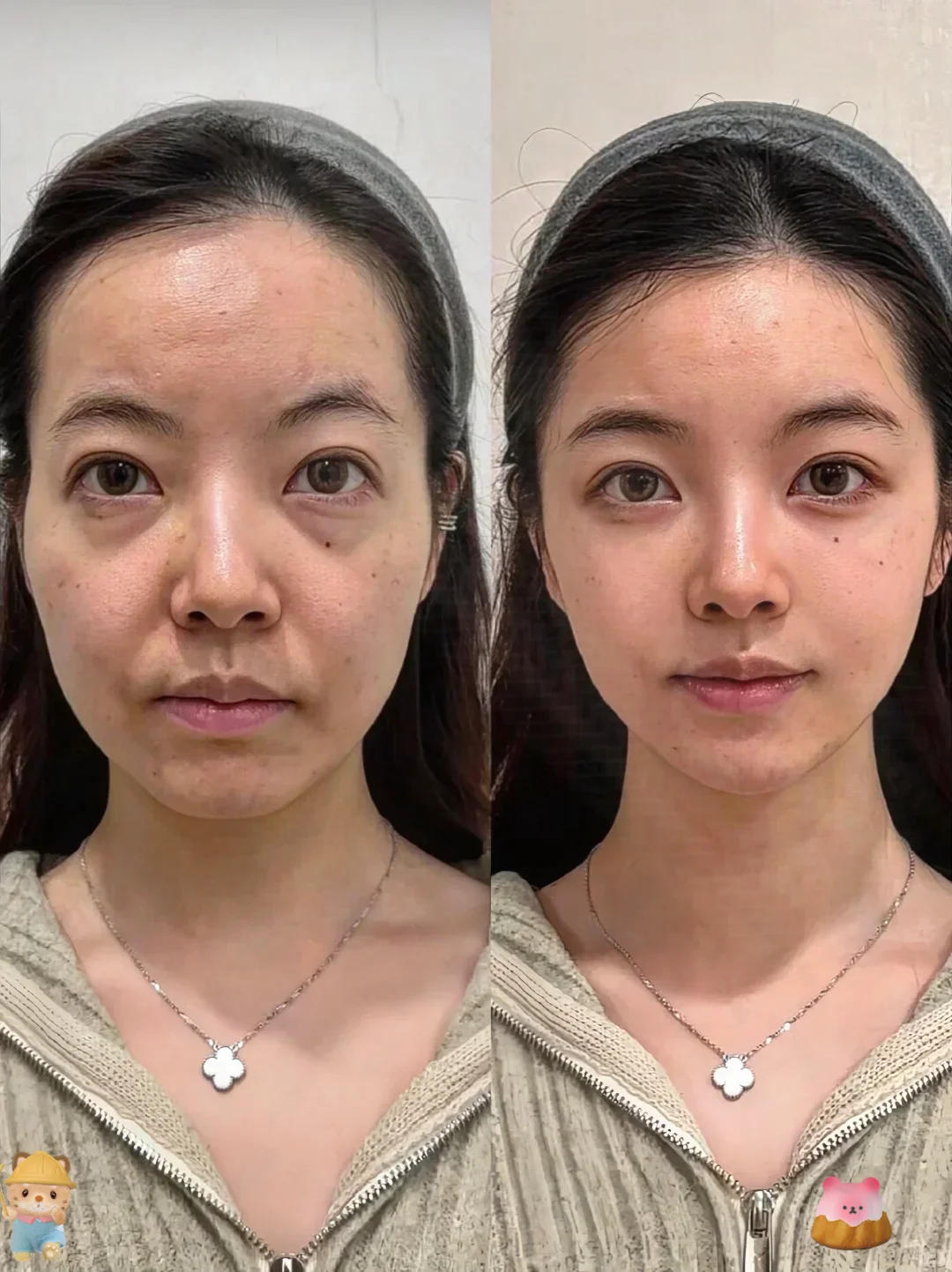打卡吹瓶子46天，脸竟砰起来了（法令纹）