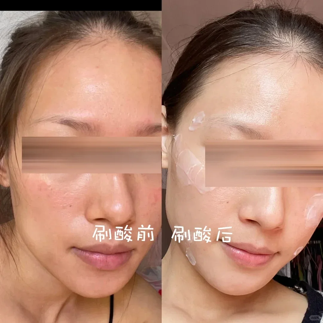大毛孔 + 泛红脸有救了！刷酸给我换脸…