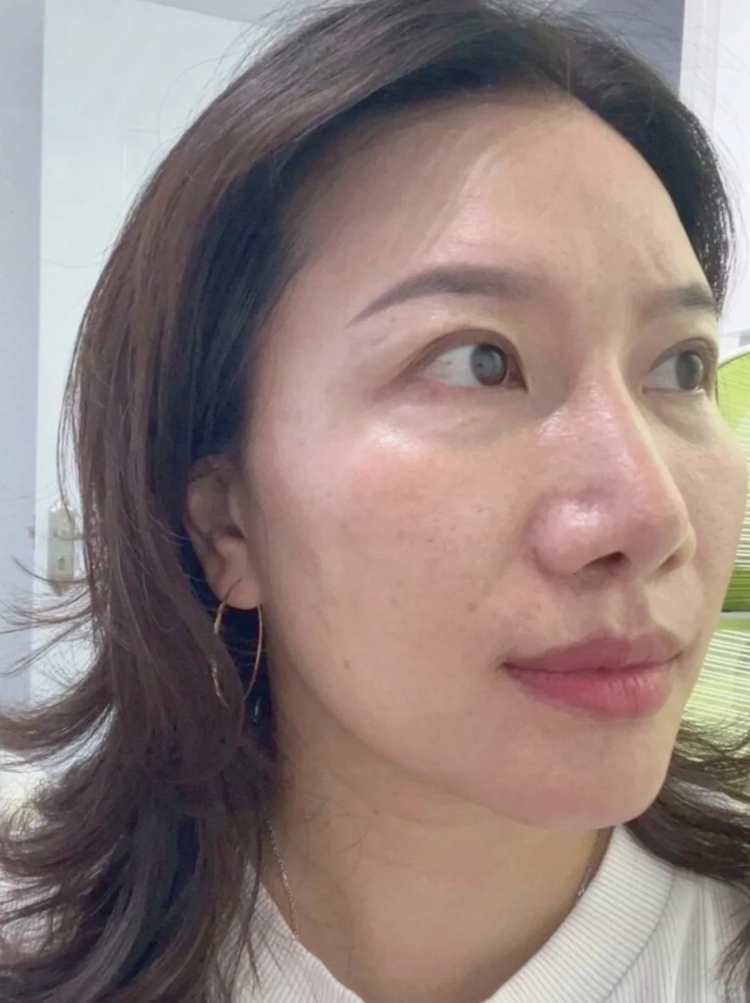 80后10年黄褐斑打卡82天
