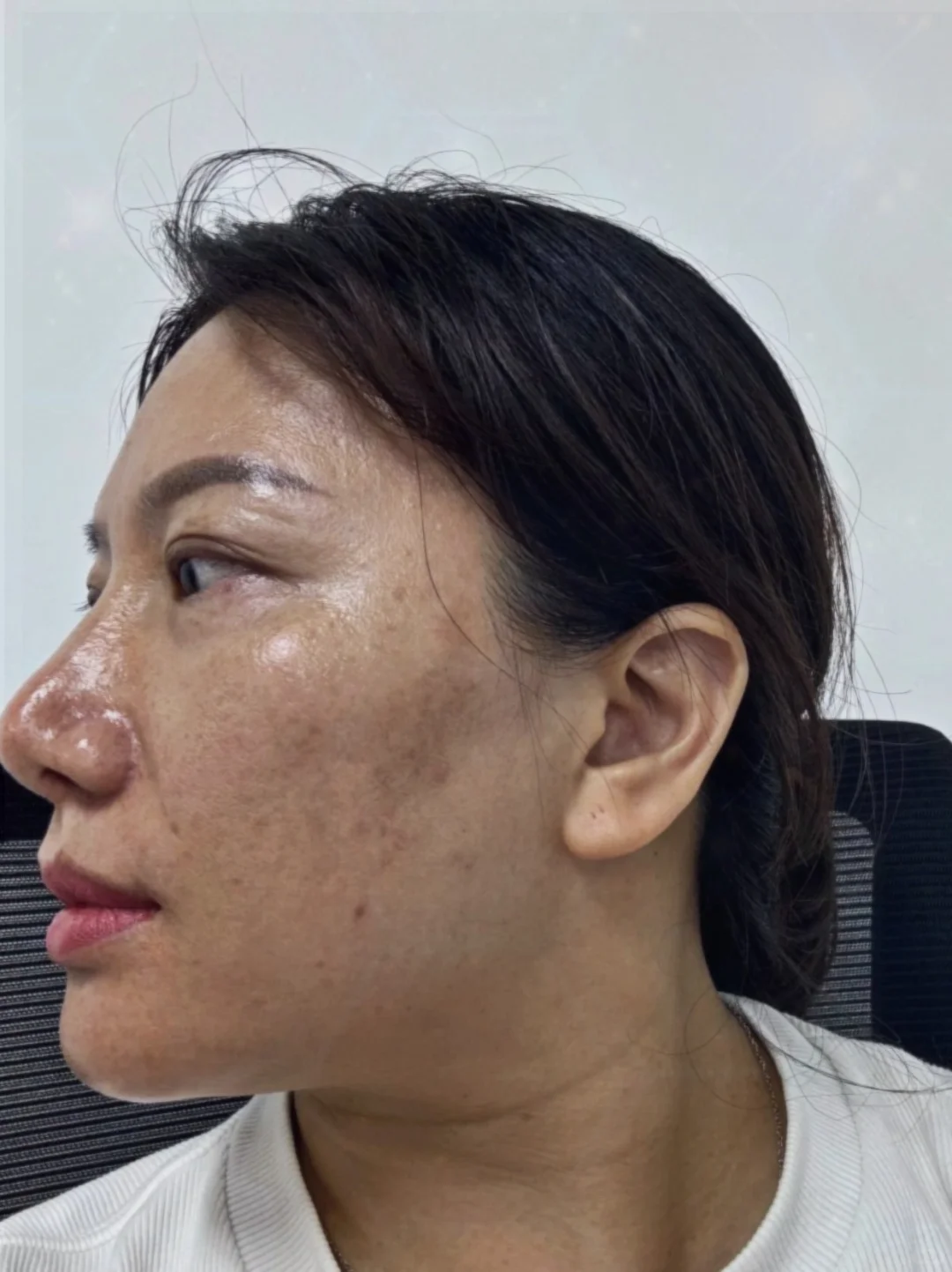 80后10年黄褐斑打卡82天