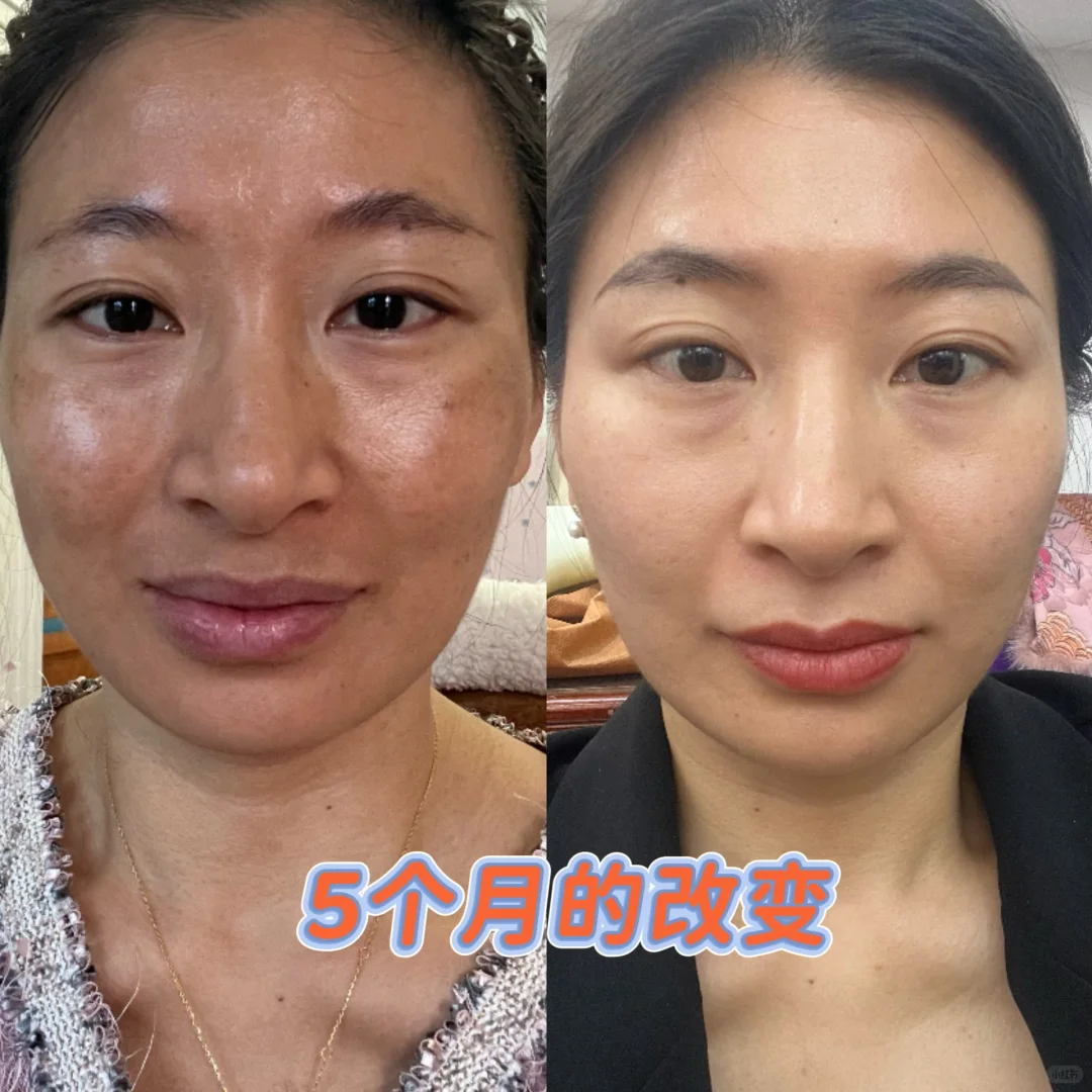 真不是换脸✔️5个月皮肤的惊人蜕变