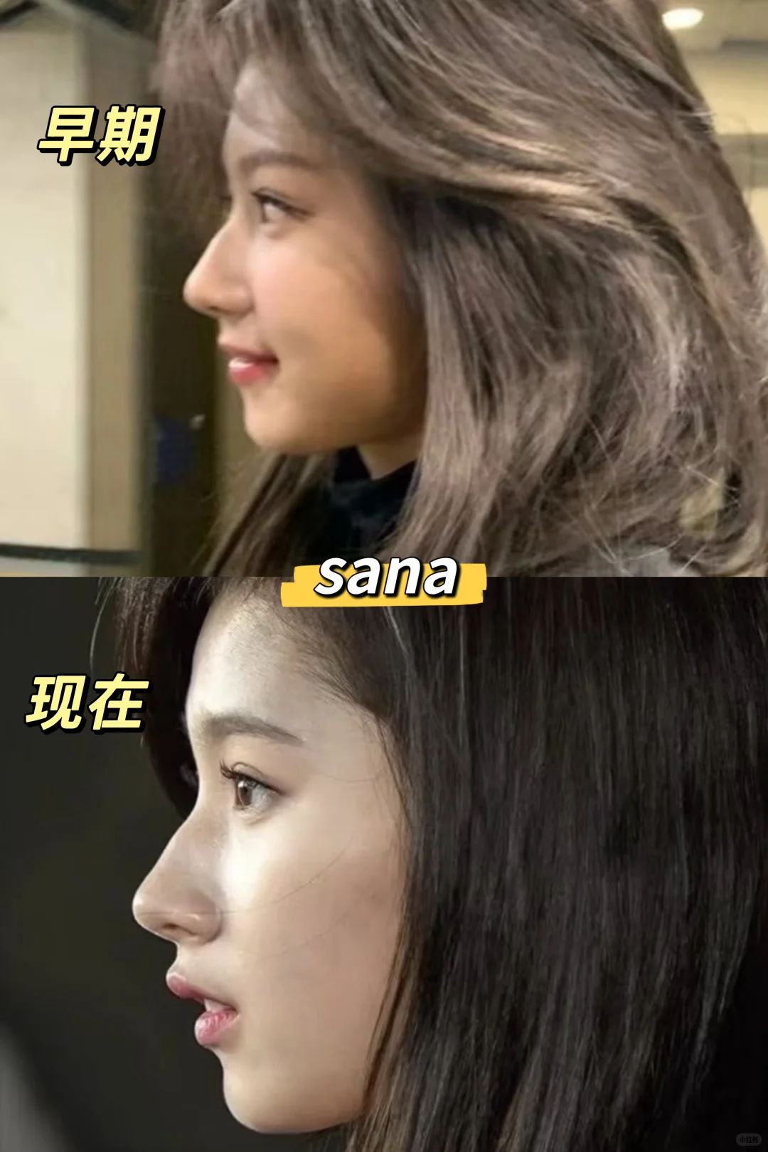 我发现嘴凸的姐妹按sana模板来微调才是真美
