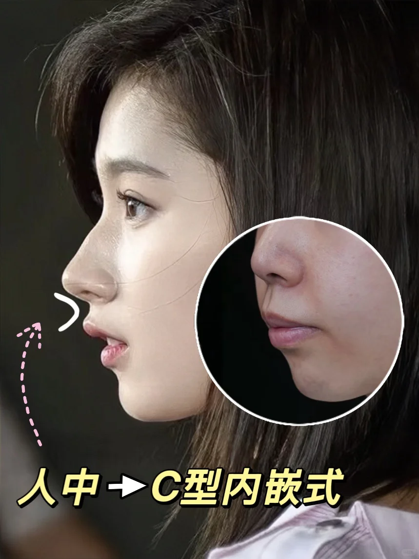 我发现嘴凸的姐妹按sana模板来微调才是真美