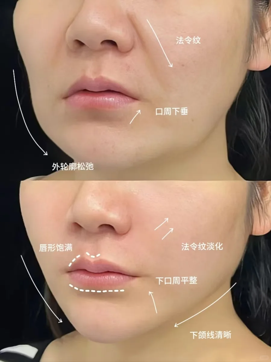 隐提美提升——改善松、垮、塌！！！！