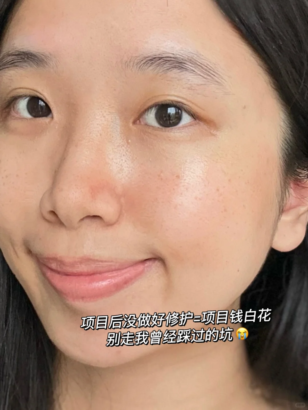 变美后烂脸？15天换皮实录