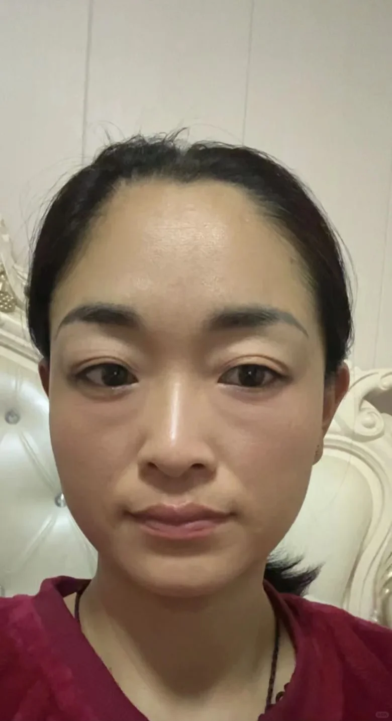 记录我大半年黄褐ban是如何淡掉的！