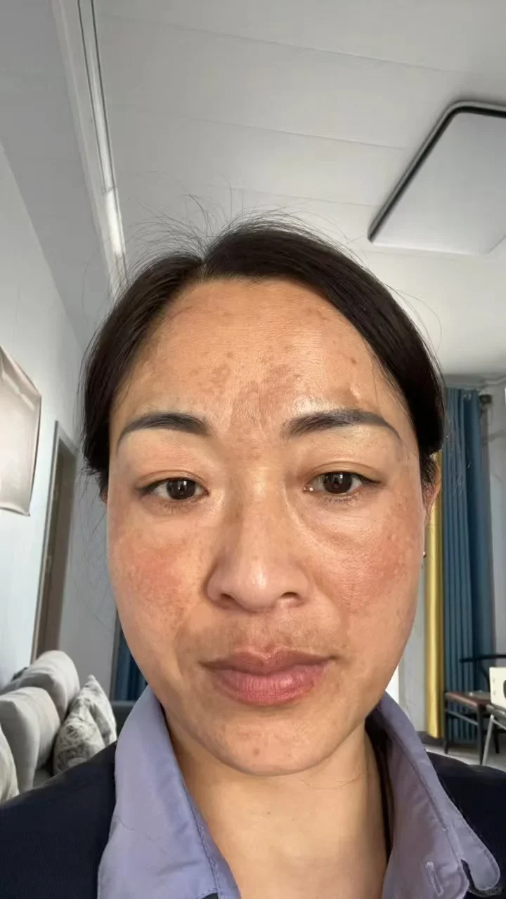 记录我大半年黄褐ban是如何淡掉的！