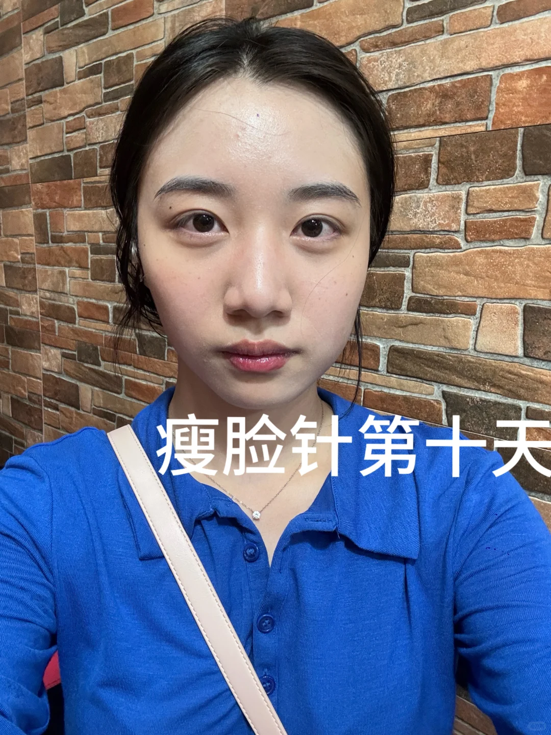 瘦脸针第十天