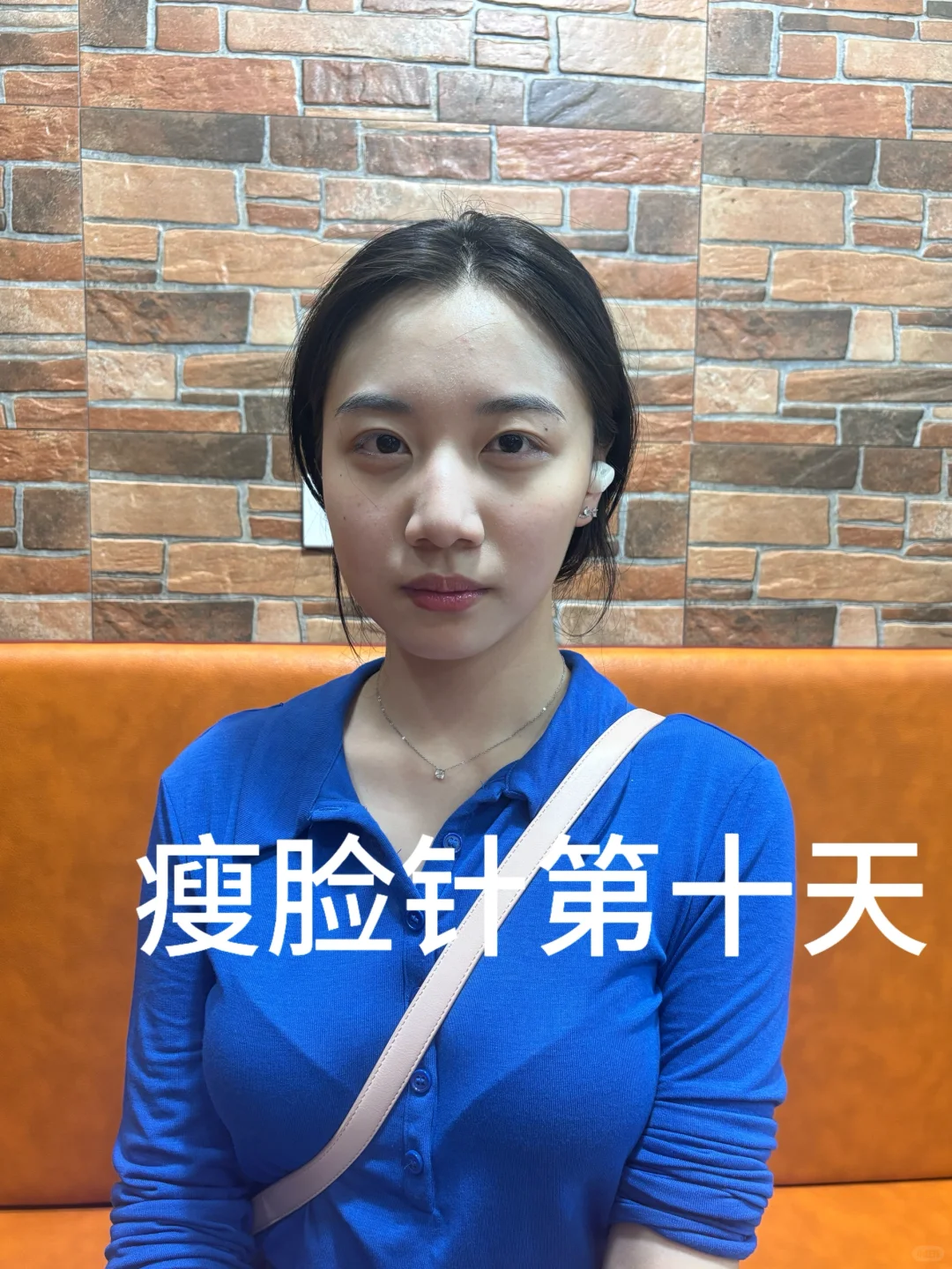 瘦脸针第十天