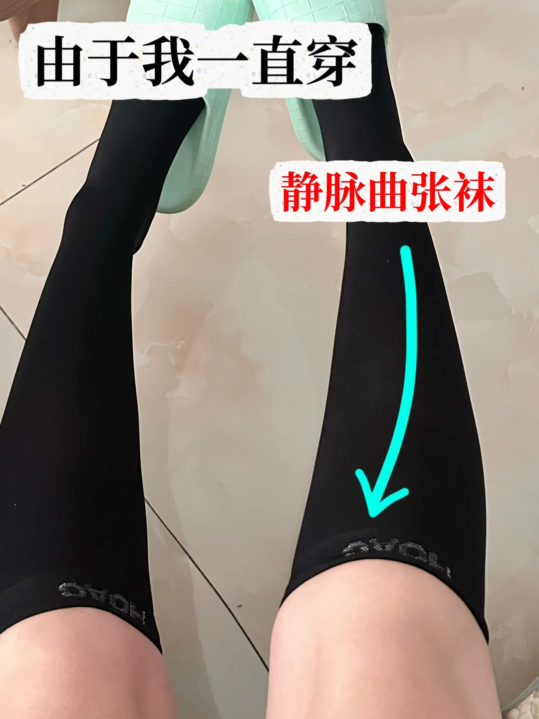 被静脉曲张折磨过的进！！