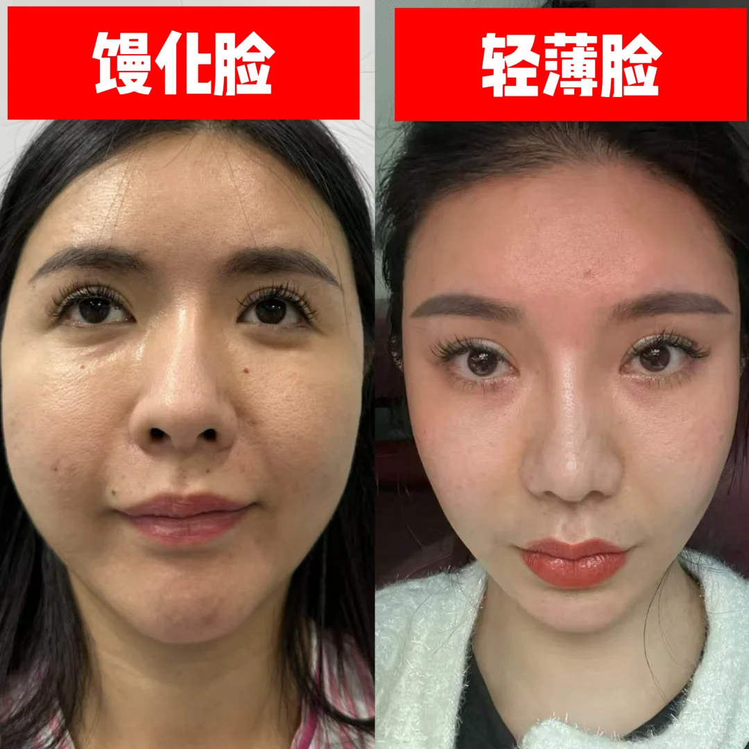 馒化脸vs轻薄脸，解脱就是这么简答
