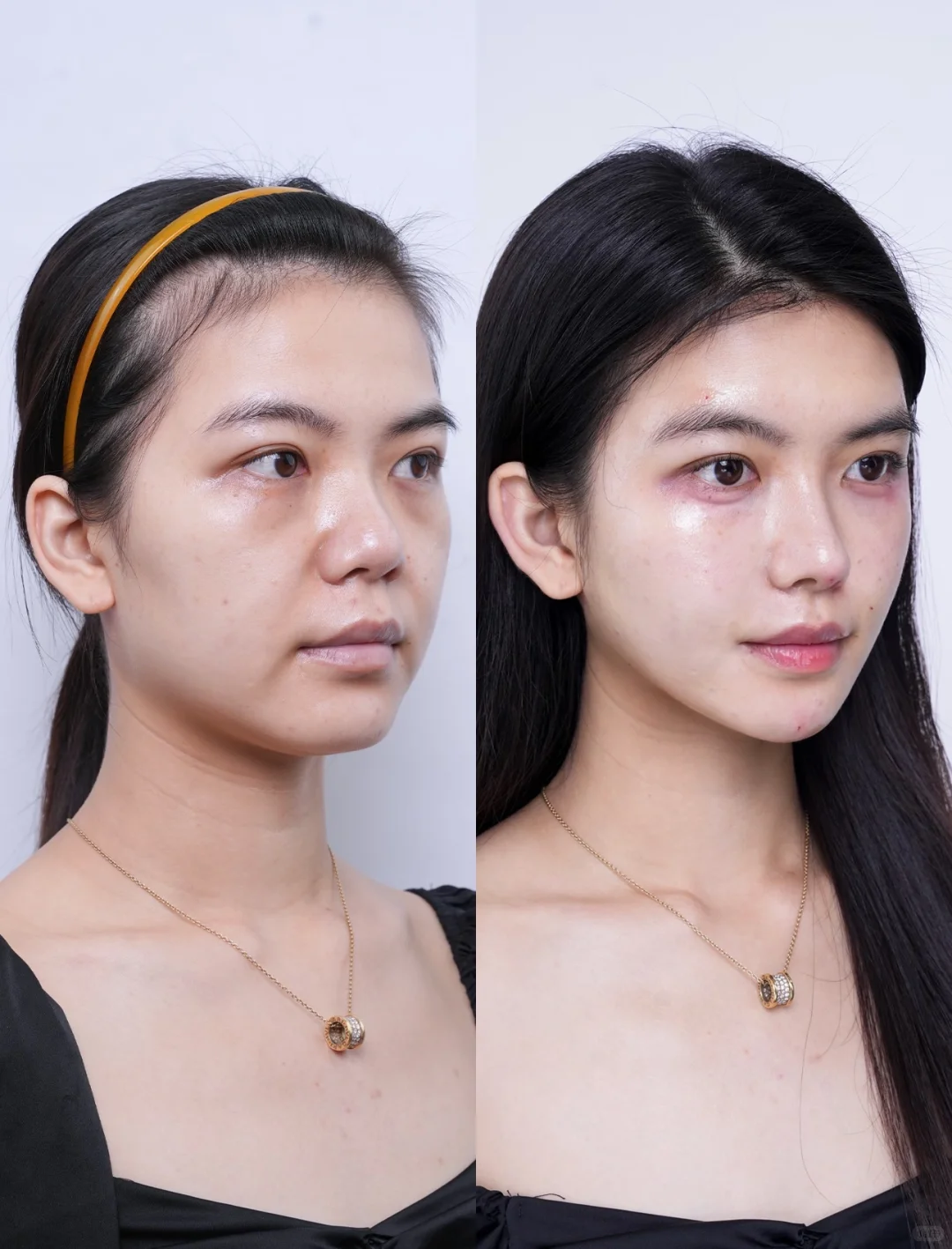 全脸微调后，姐的美貌到了下一个level～