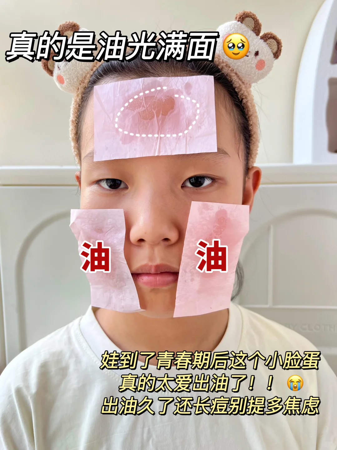 不花冤枉钱❗青春期油痘肌爆改妈生好皮