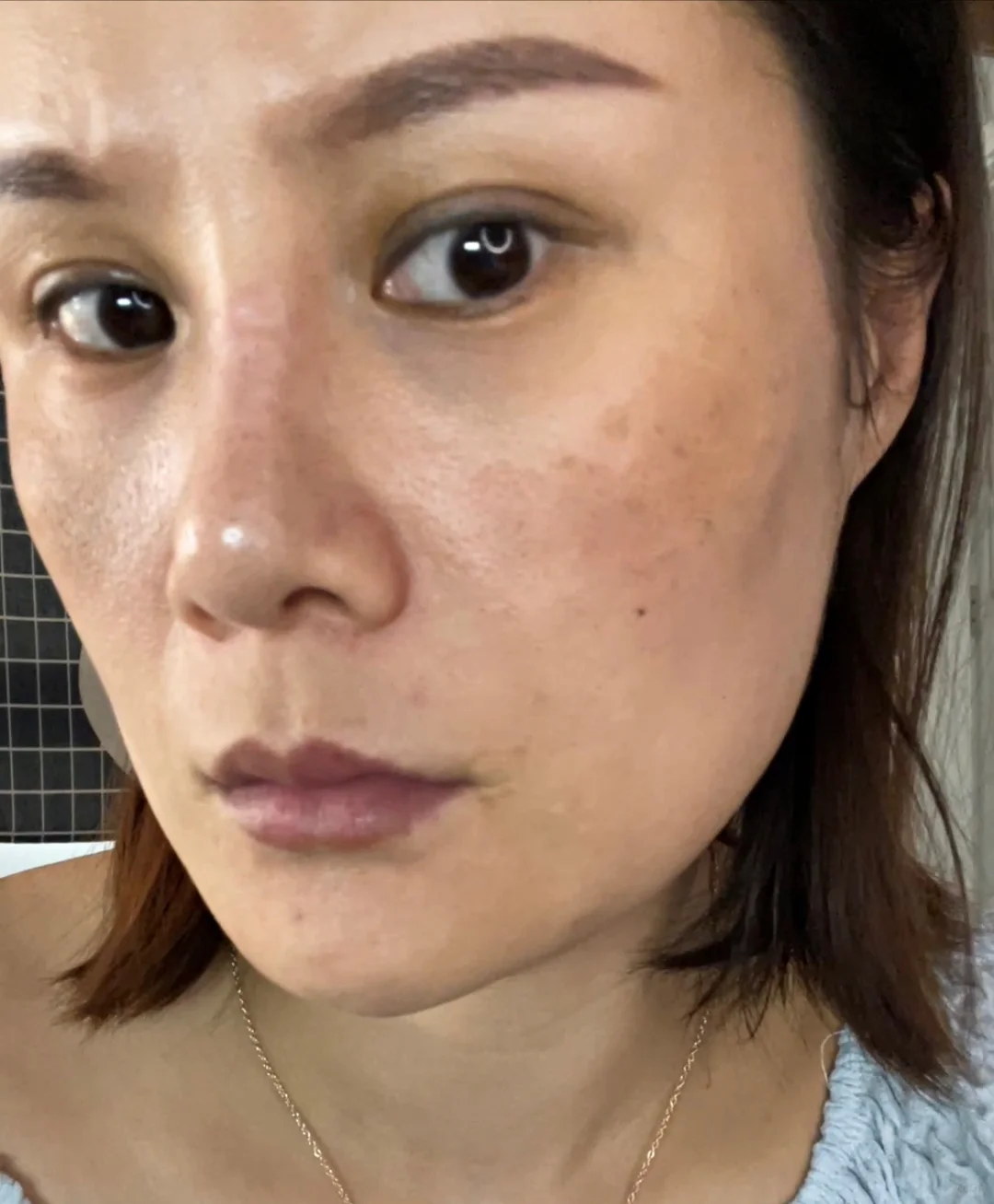 黄褐斑的苦尽甘来