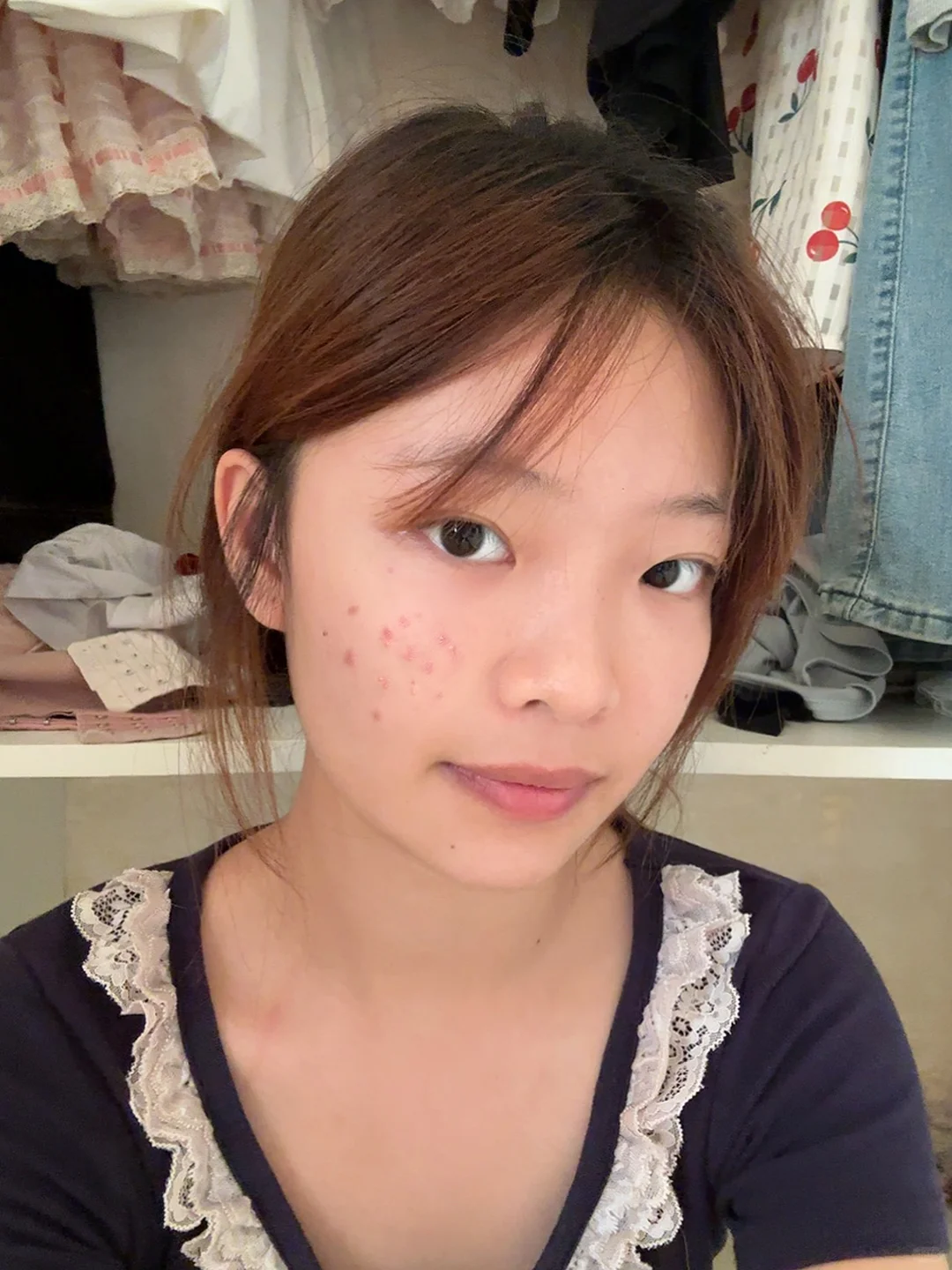和痘痘和解的第 N 天~