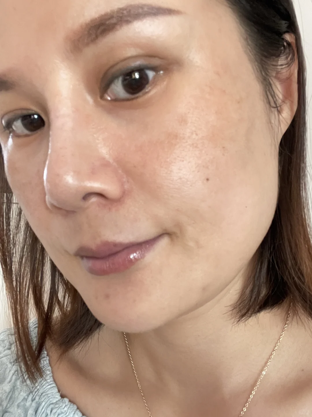 黄褐斑的苦尽甘来