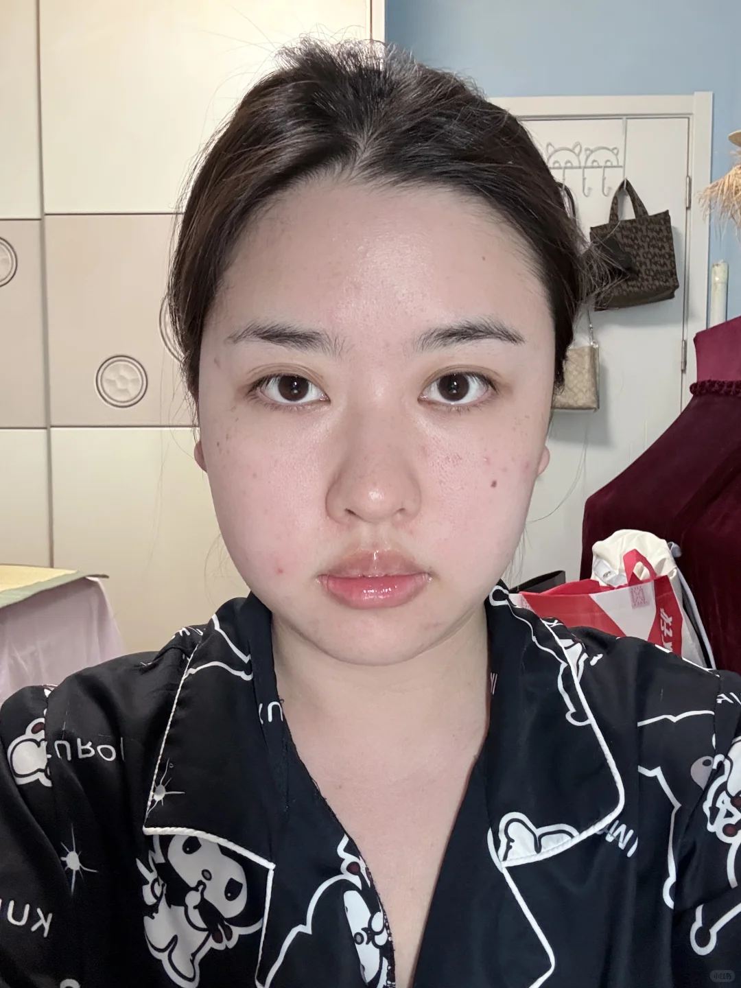 方圆脸瘦脸针三个月前后对比