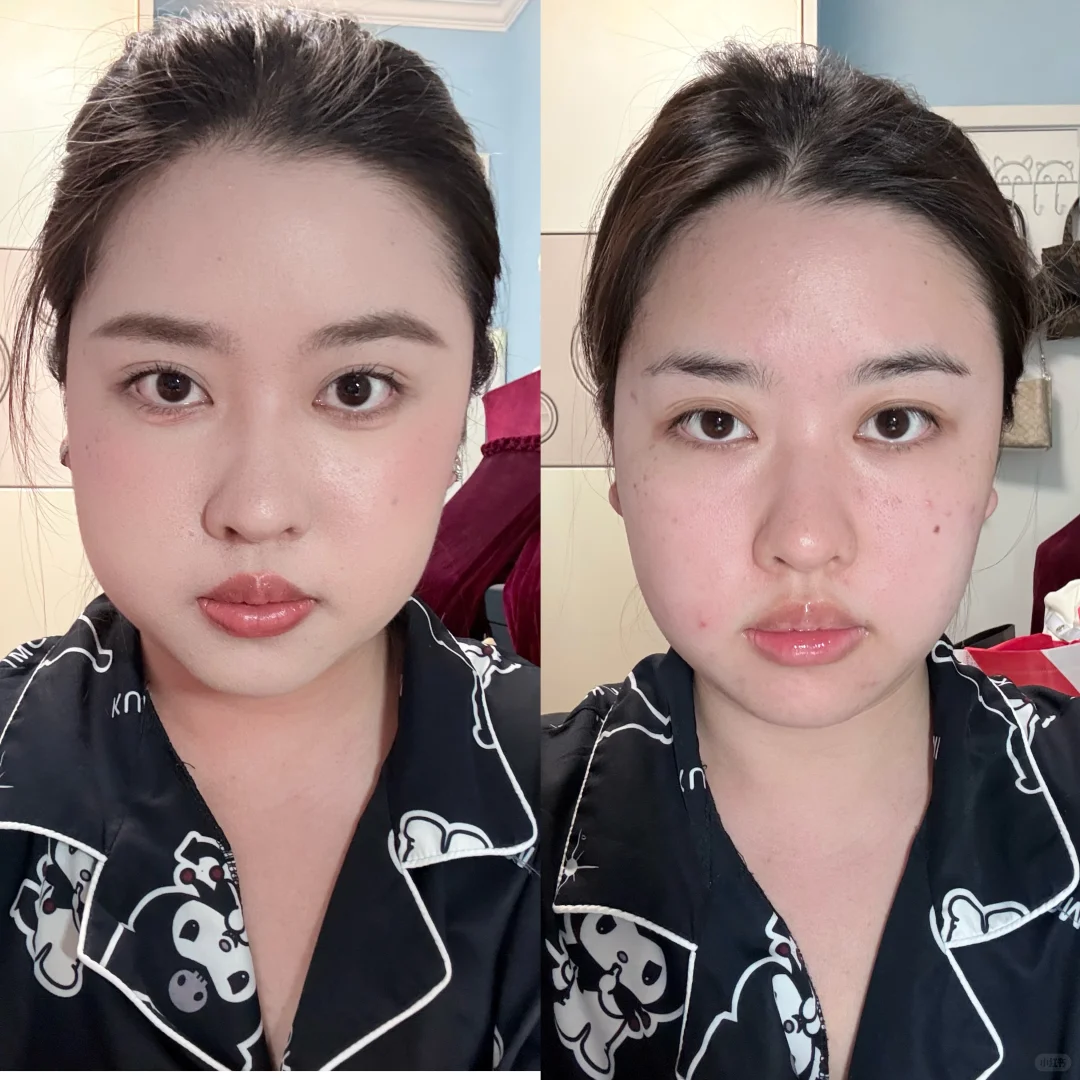 方圆脸瘦脸针三个月前后对比