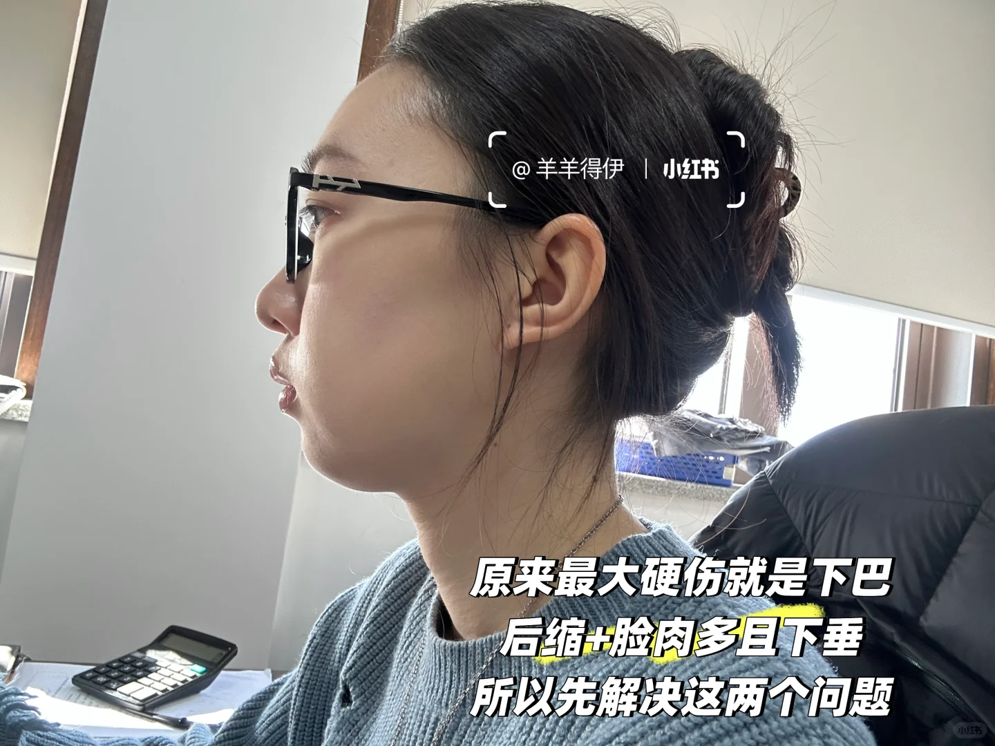 肉肉脸+下巴后缩的变美思路分享2.0