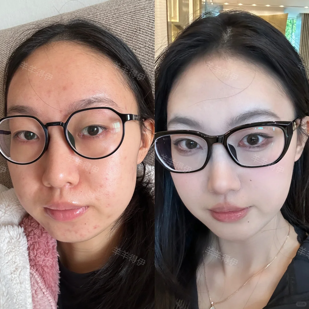 肉肉脸+下巴后缩的变美思路分享2.0