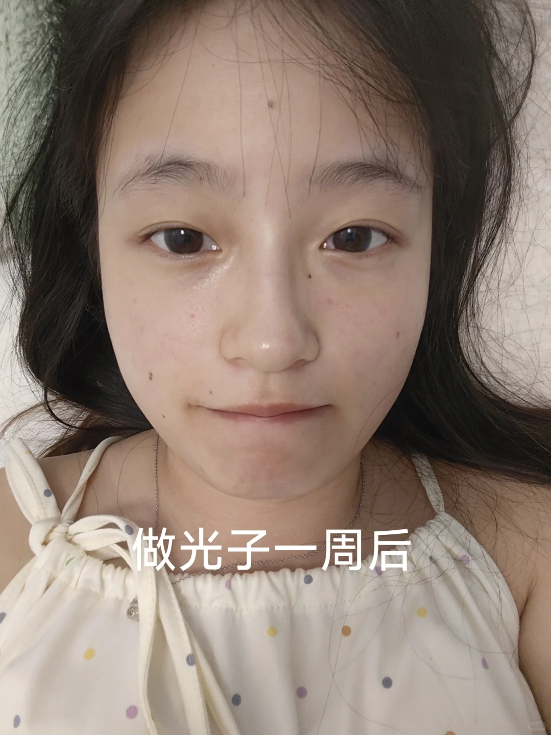 第二次光子前后对比图