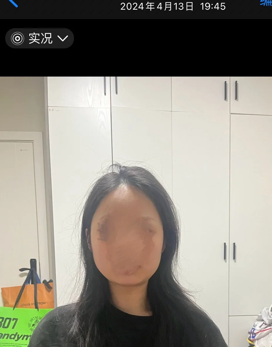天生瘦脸圣体！💉