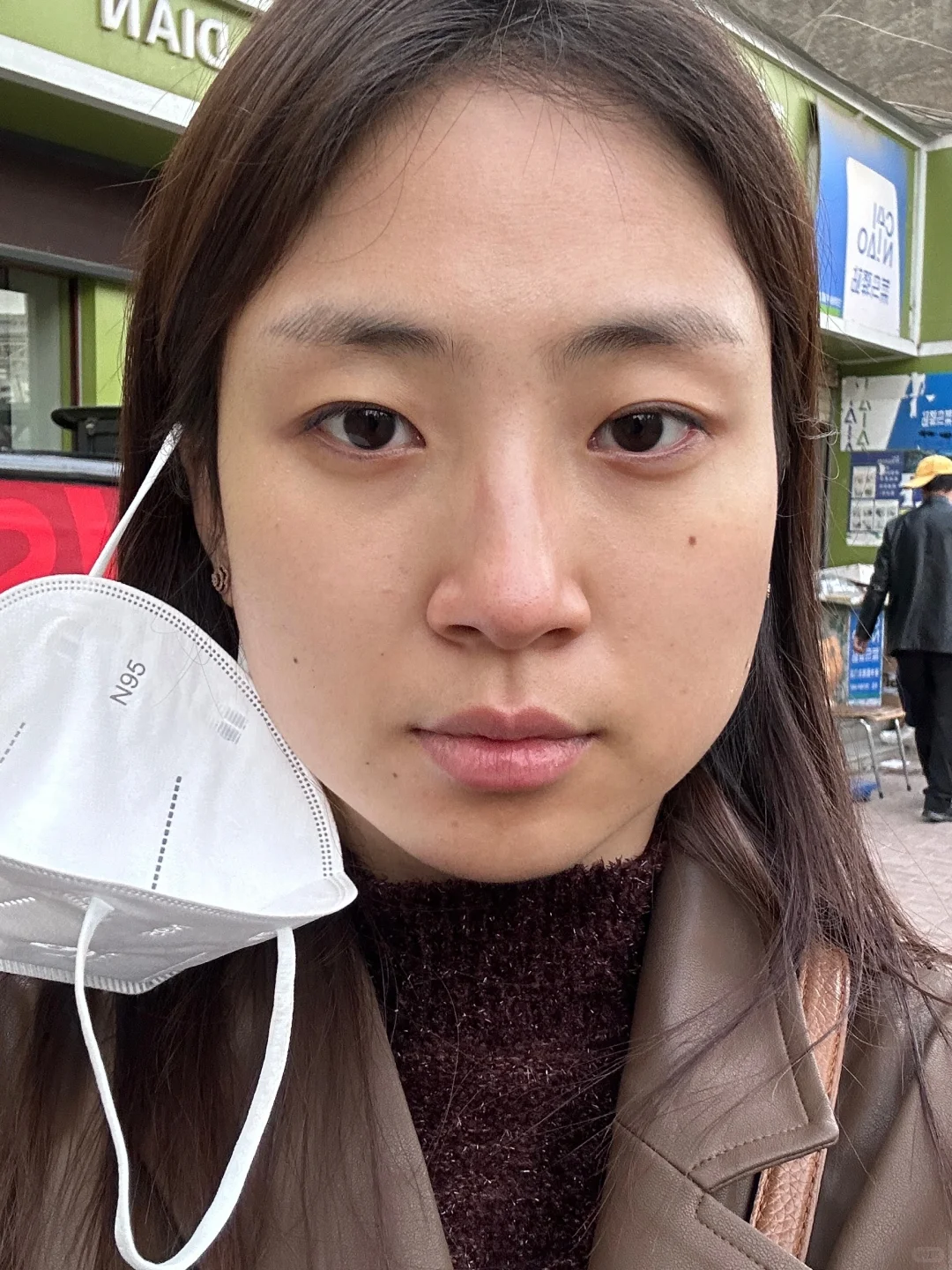 25岁阔面小方脸打瘦脸针