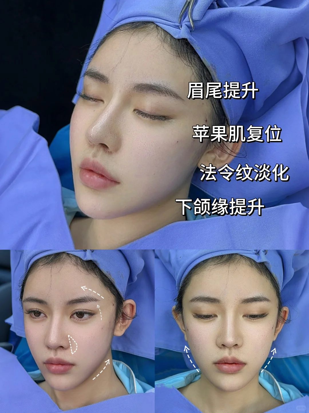 30+，终于找对了轻薄脸的提升思路