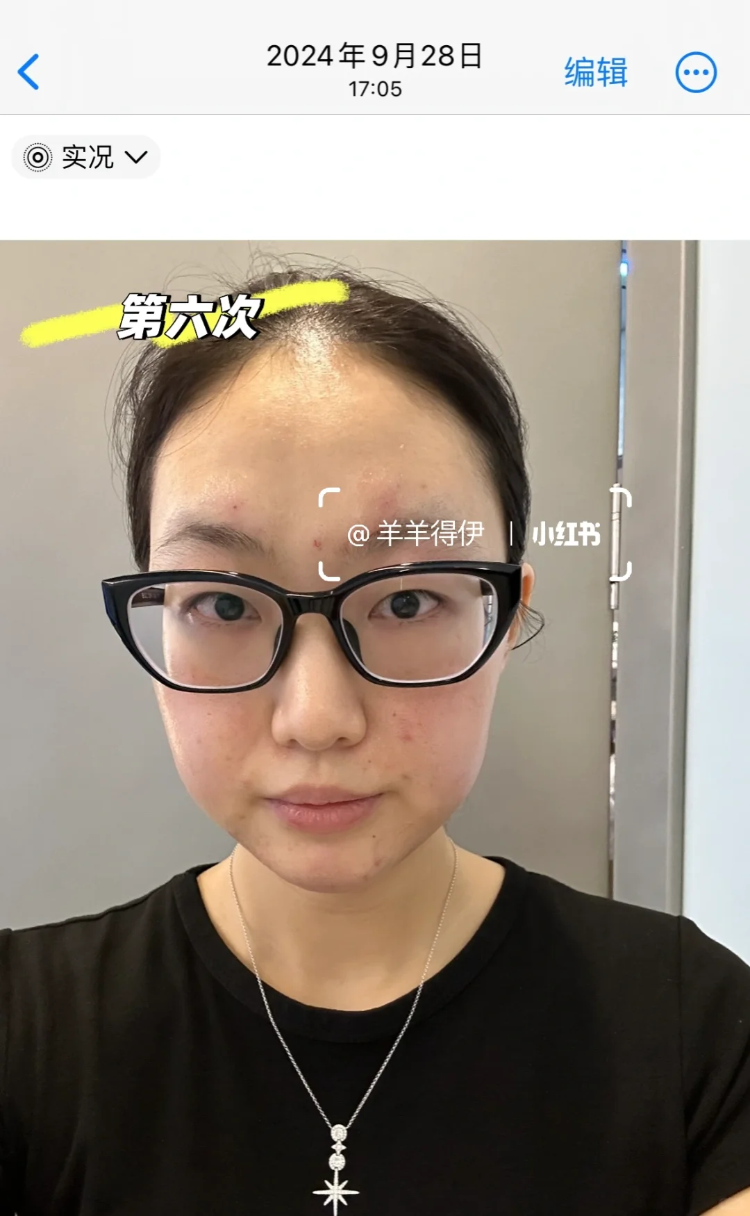 关于我九个月时间做了九次钻石超塑…