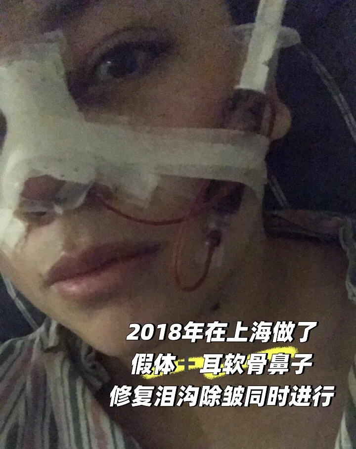 为了变美花了一辆奔驰在脸上8年后怎么样了？