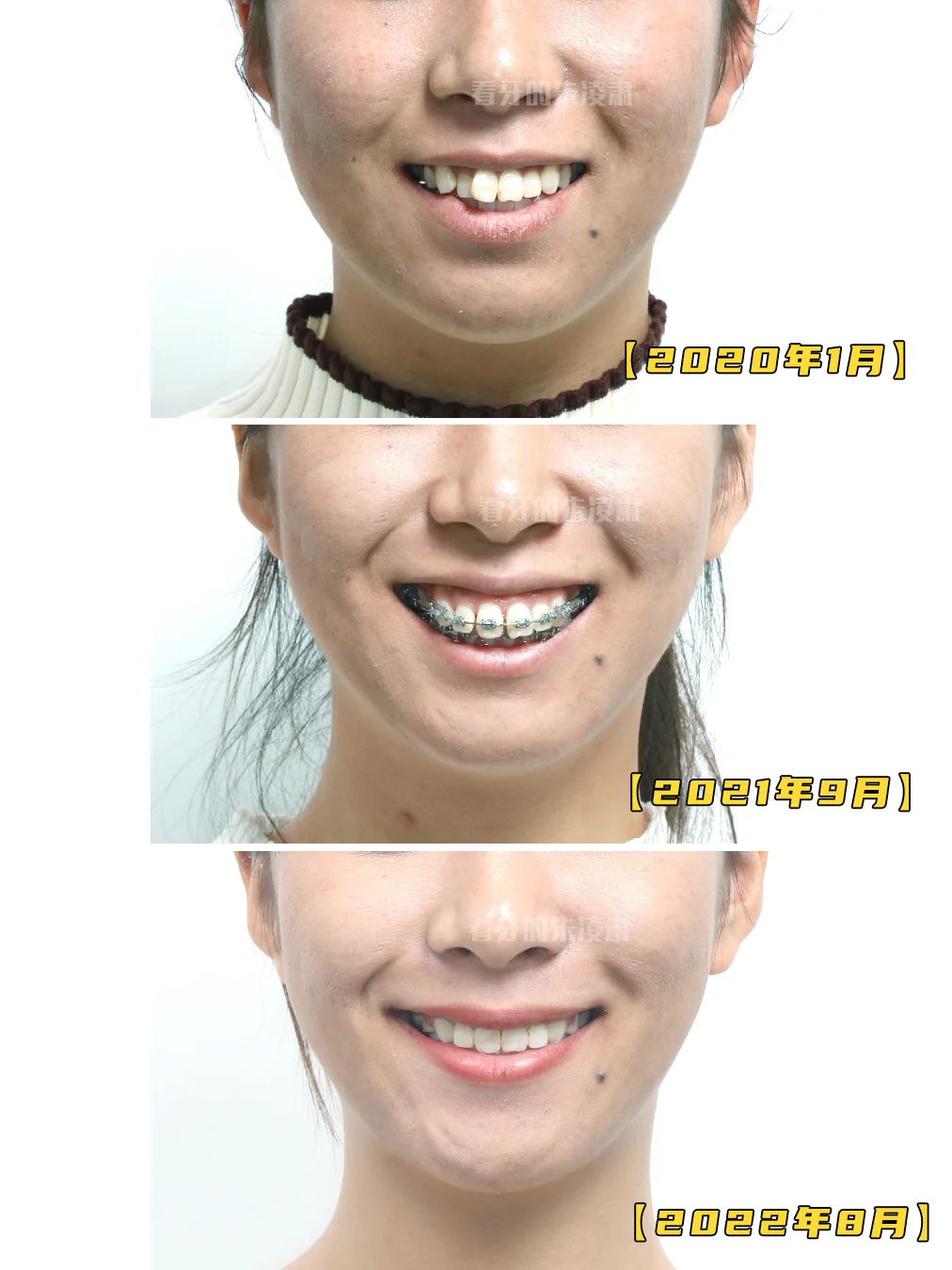 上半张脸决定美，下半张脸决定丑