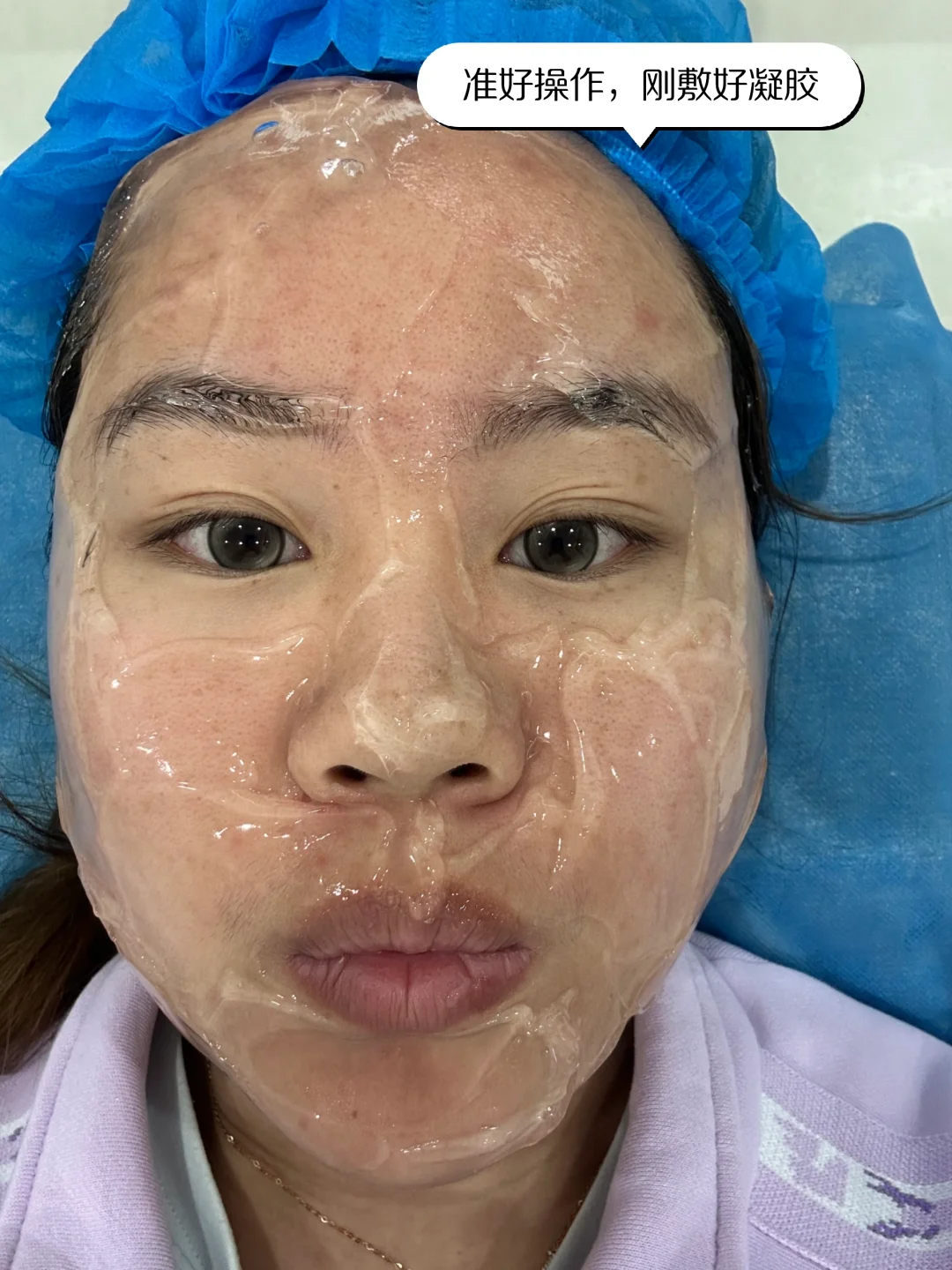 医美小白第一次光子嫩肤DAY5！